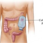 ileostomia-amy-garcia-michigan ileostomia-amy-garcia-michigan